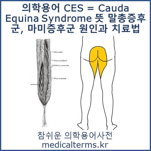 의학용어 CES = Cauda Equina Syndrome 뜻 말총증후군, 마미증후군 원인과 치료법