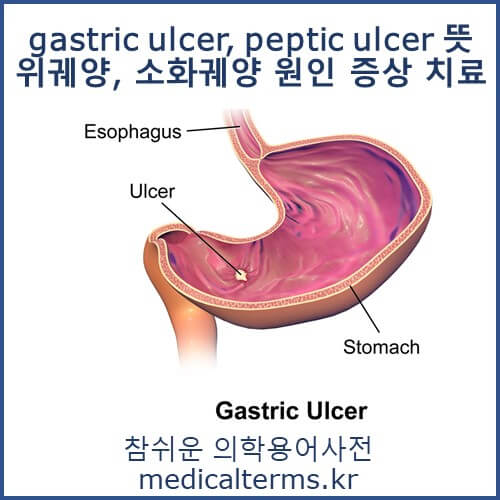 의학용어 gastric ulcer, peptic ulcer 뜻 위궤양, 소화성궤양 원인 증상 치료