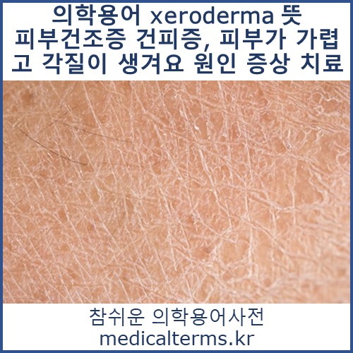 의학용어 xeroderma 뜻 피부건조증 건피증, 로션을 발라도 피부가 가렵고 각질이 일어나요 원인 증상 치료
