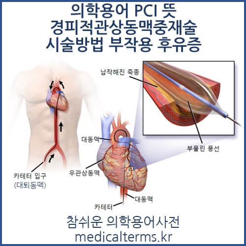 의학용어 PCI 뜻 경피적관상동맥중재술 시술방법 부작용 후유증