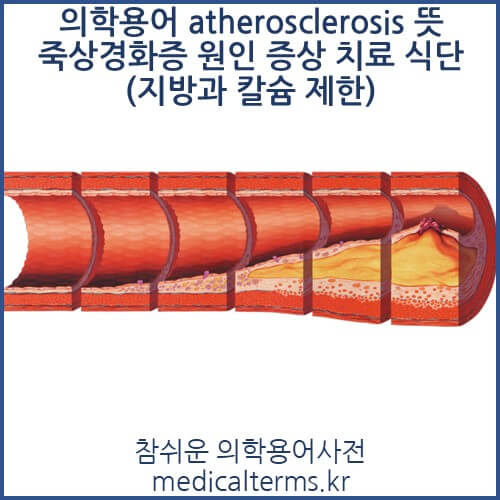 의학용어 atherosclerosis 뜻 죽상경화증 원인 증상 치료 식단(지방과 칼슘 제한)