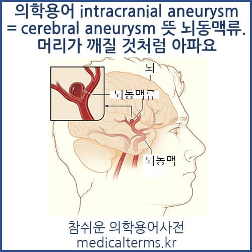 의학용어 intracranial aneurysm = cerebral aneurysm 뜻 뇌동맥류. 머리가 깨질 것처럼 아파요