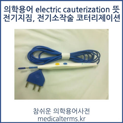 의학용어 electric cauterization 뜻 전기지짐, 전기소작술 코터리제이션
